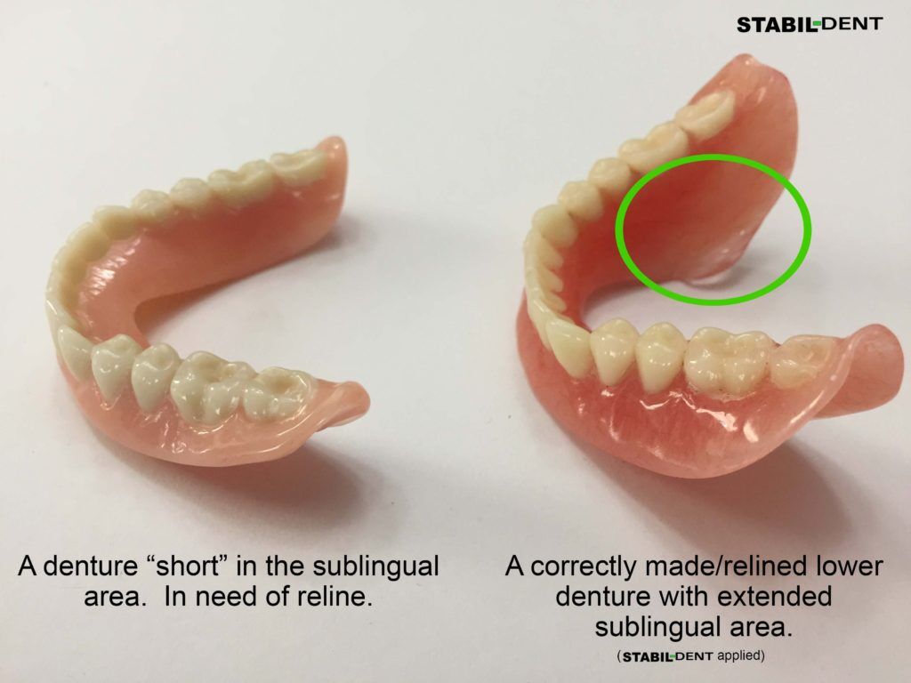 Lower Denture Reline Kit